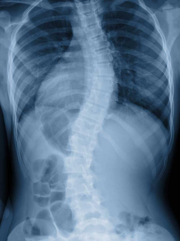 Scoliosis Treatment Chiropractor
